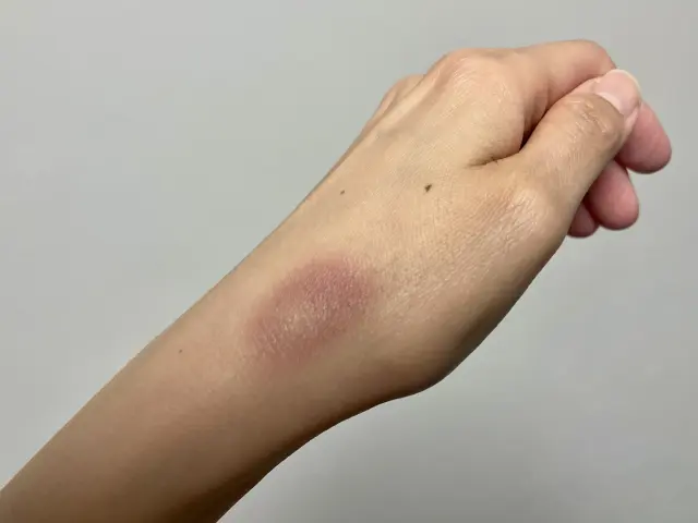 皮膚が黄緑色になる原因とは？あざの色の変化と病気のサインを徹底解説